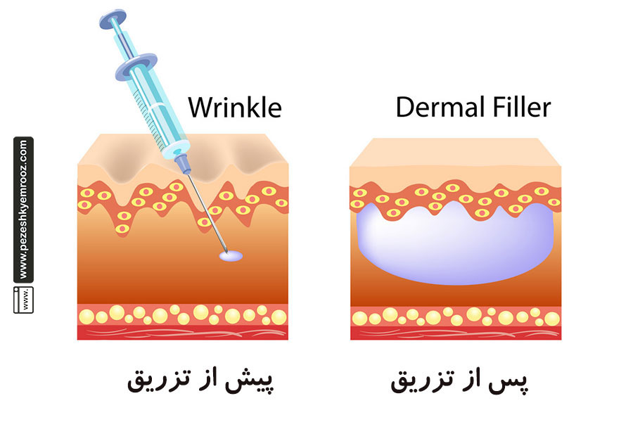 پوست| کلاژن| سلول| بافت| رژیم غذایی| فیلرهای پوستی